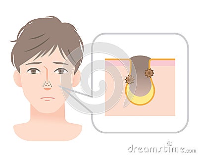 Clogged pores on nose of young menâ€™s face Vector Illustration